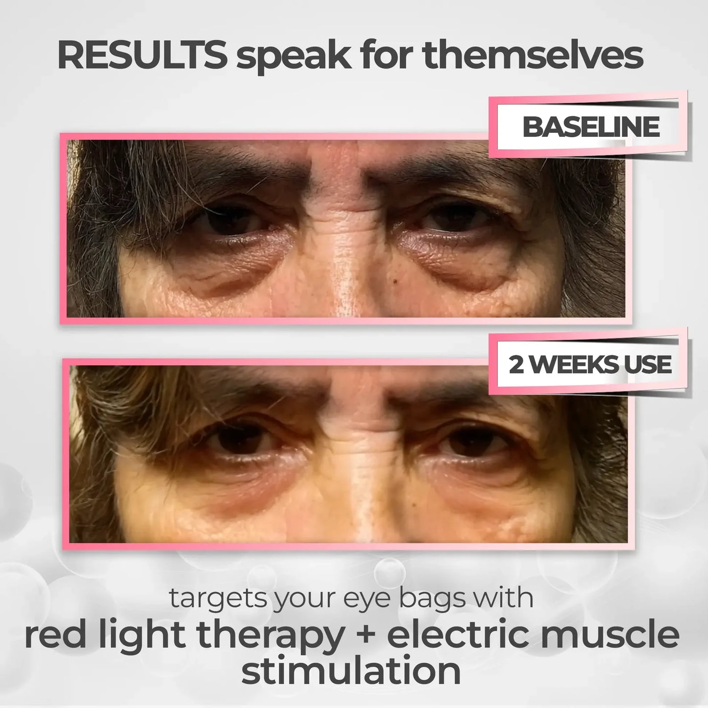 Lumoriu EyeLift Pro