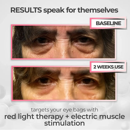 Lumoriu EyeLift Pro